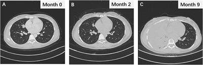 Case Report: Termination of unplanned pregnancy led to rapid deterioration of non-small-cell lung cancer during osimertinib treatment